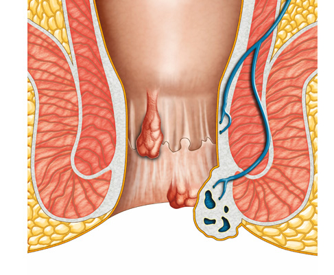 Hip Replacement Surgery in Lucknow