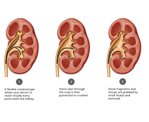 Hip Replacement Surgery in Lucknow