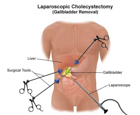 Hip Replacement Surgery in Lucknow