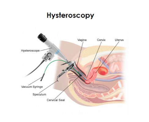 Hip Replacement Surgery in Lucknow