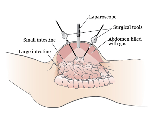 Hip Replacement Surgery in Lucknow