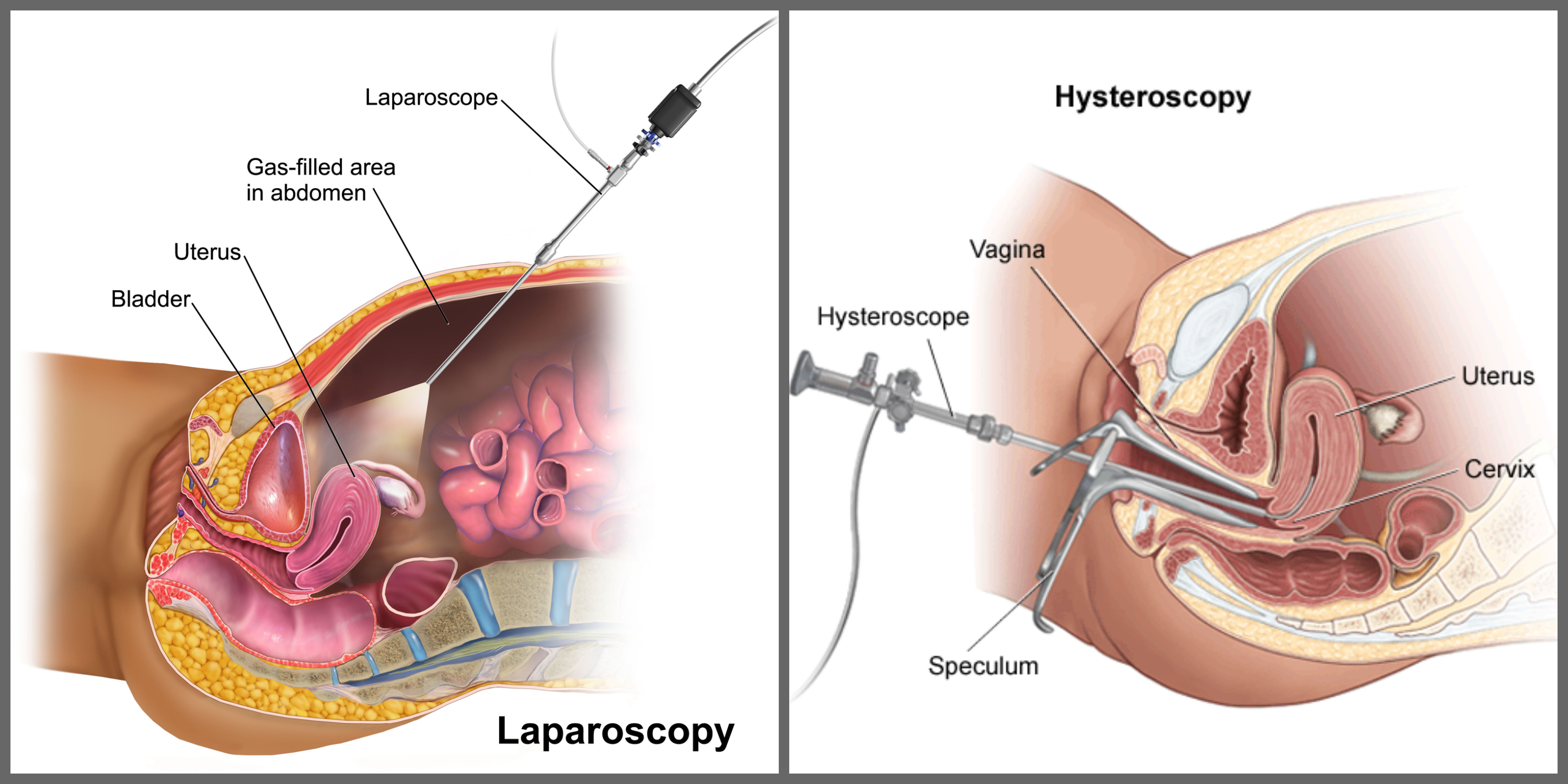hip replacement diagram