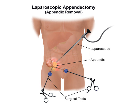 hip replacement diagram