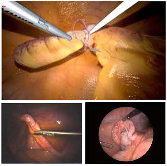 hip replacement diagram