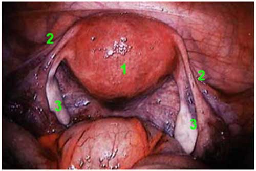 hip replacement diagram
