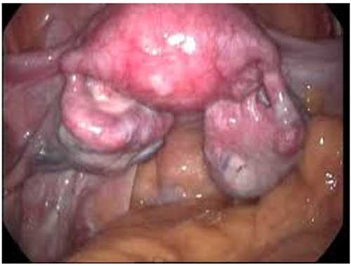 hip replacement diagram