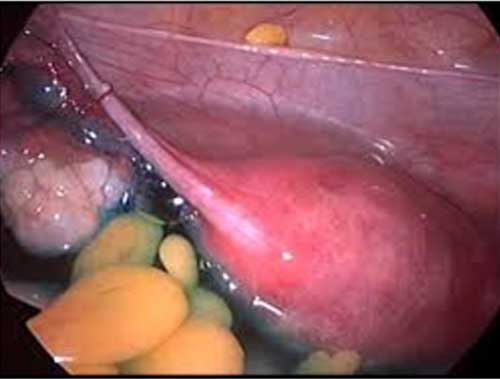hip replacement diagram