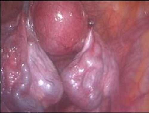 hip replacement diagram