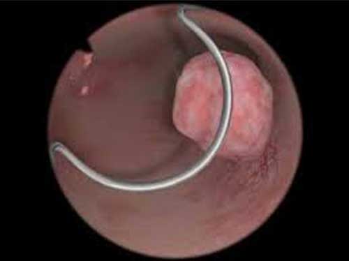 hip replacement diagram