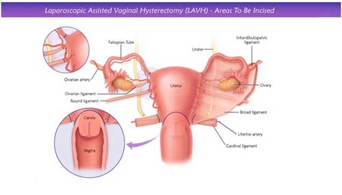 hip replacement diagram