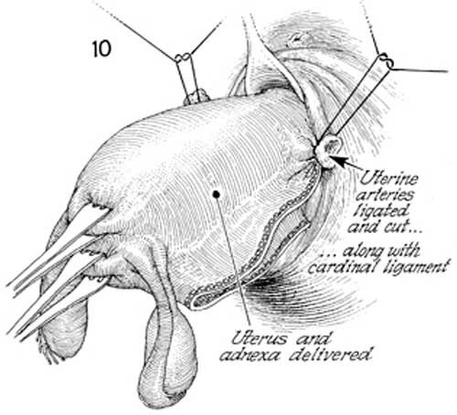 hip replacement diagram