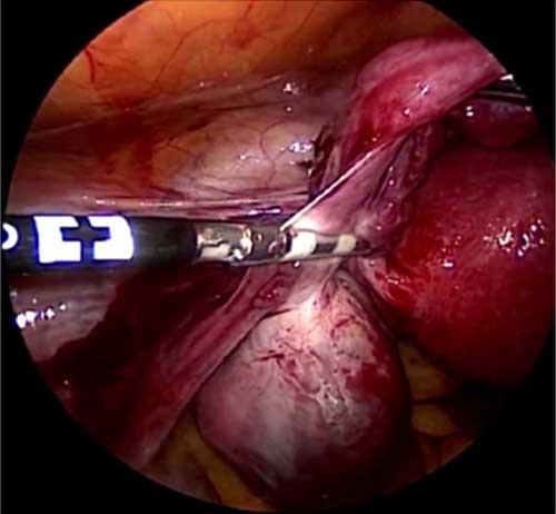 hip replacement diagram