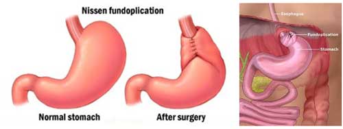 hip replacement diagram