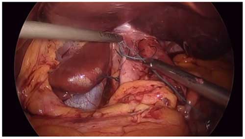 hip replacement diagram