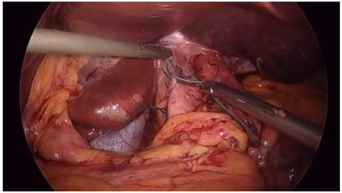 hip replacement diagram