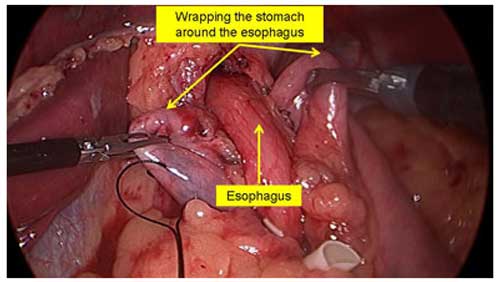 hip replacement diagram
