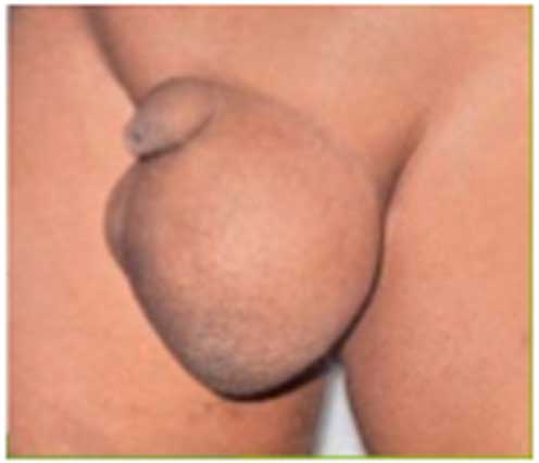 hip replacement diagram