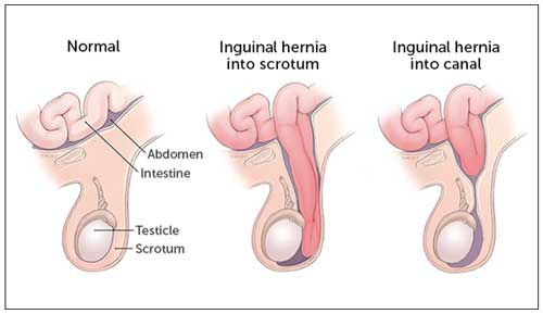hip replacement diagram