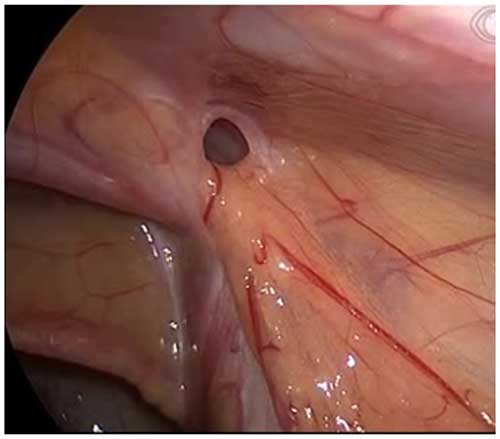 hip replacement diagram