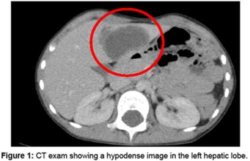 hip replacement diagram