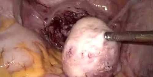 hip replacement diagram