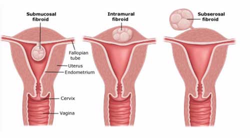 hip replacement diagram