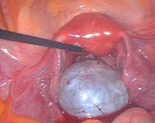 hip replacement diagram