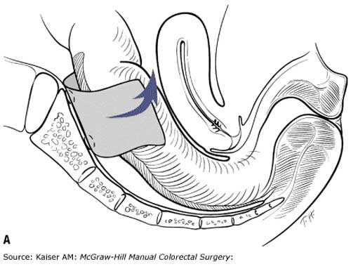 hip replacement diagram