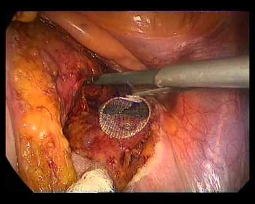 hip replacement diagram