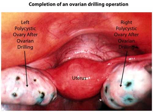 hip replacement diagram