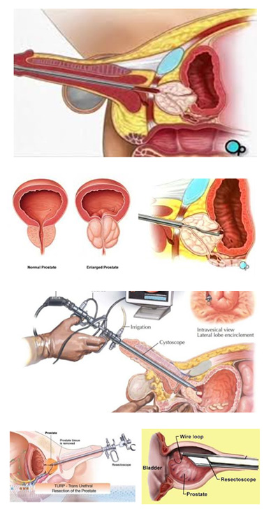 hip replacement diagram