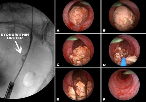 URS (Ureterorenoscopy)